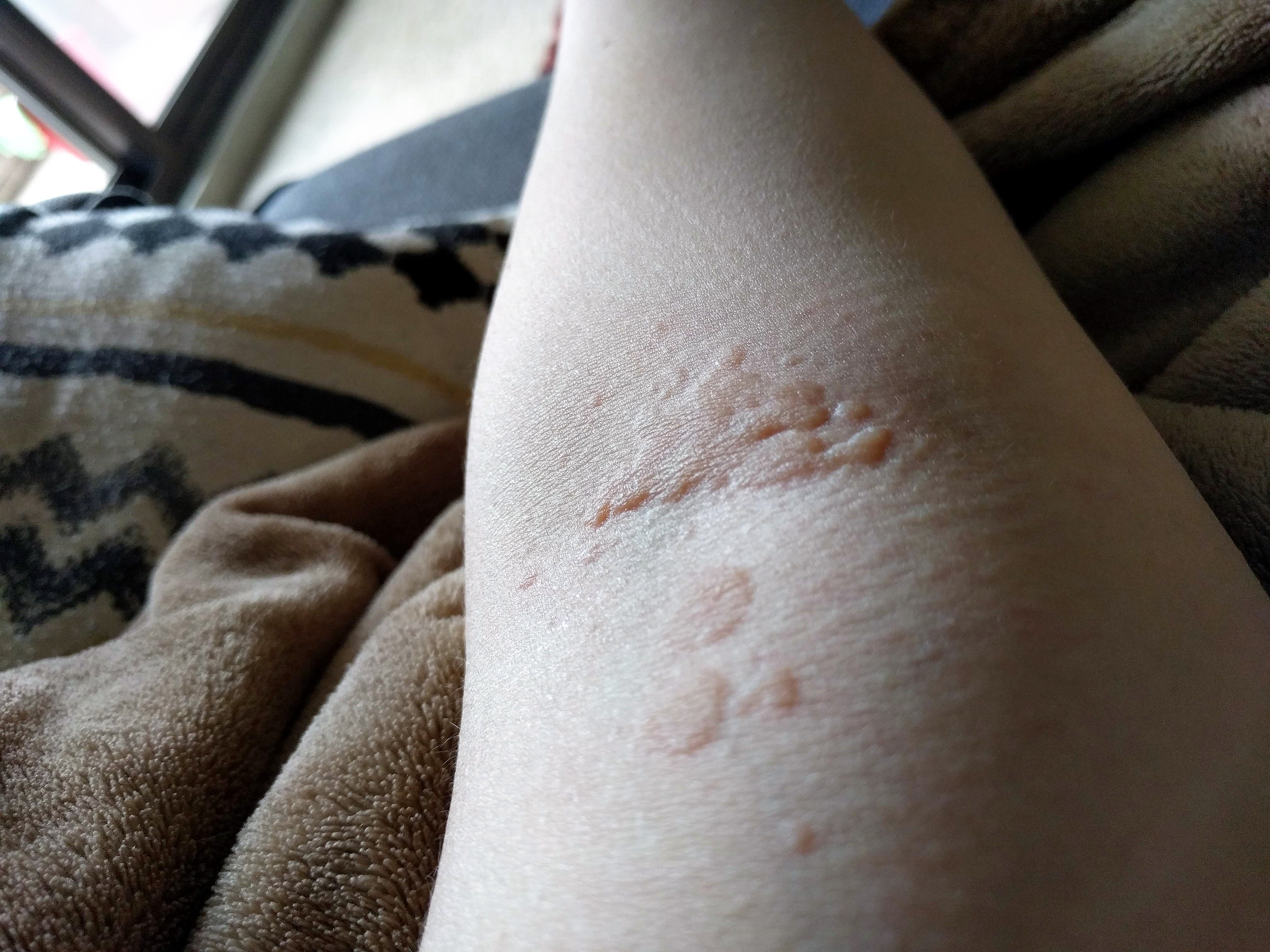 tiny pinpoint rash